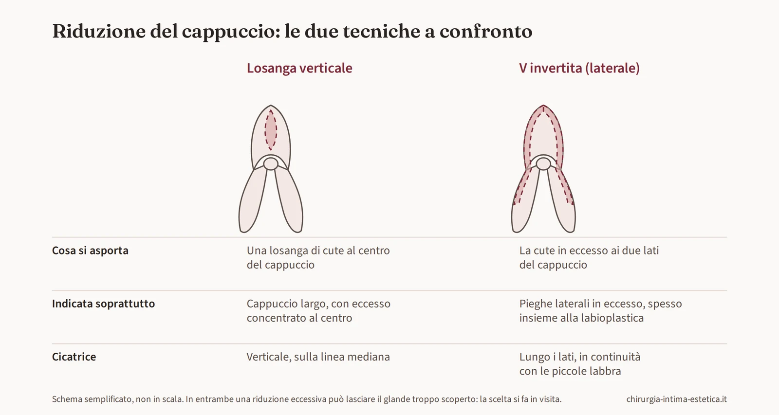 Schema di confronto tra le due tecniche di riduzione del cappuccio clitorideo: losanga verticale centrale e V invertita laterale