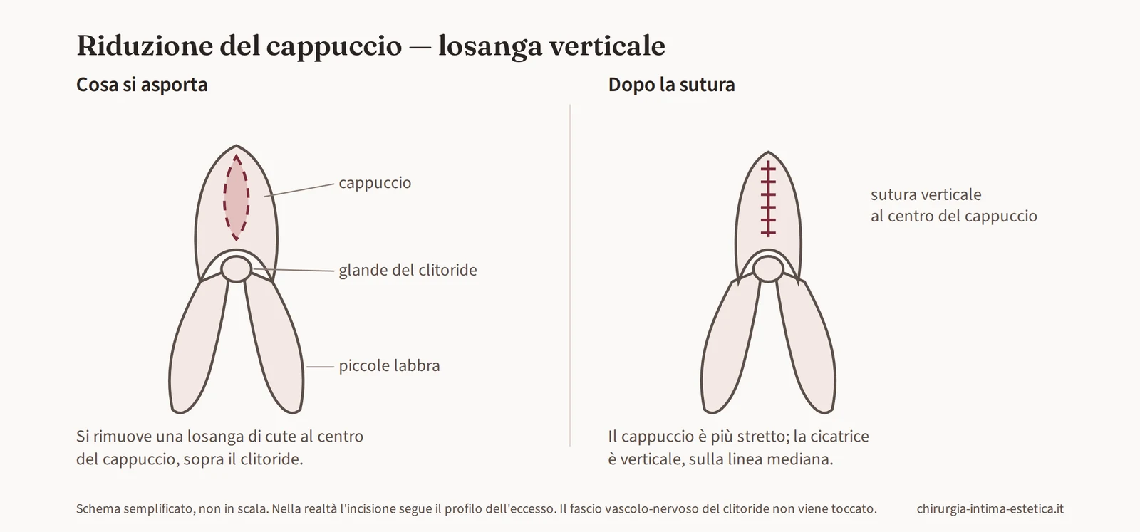 Schema della riduzione del cappuccio con losanga verticale: asportazione di cute al centro del cappuccio e sutura verticale sulla linea mediana