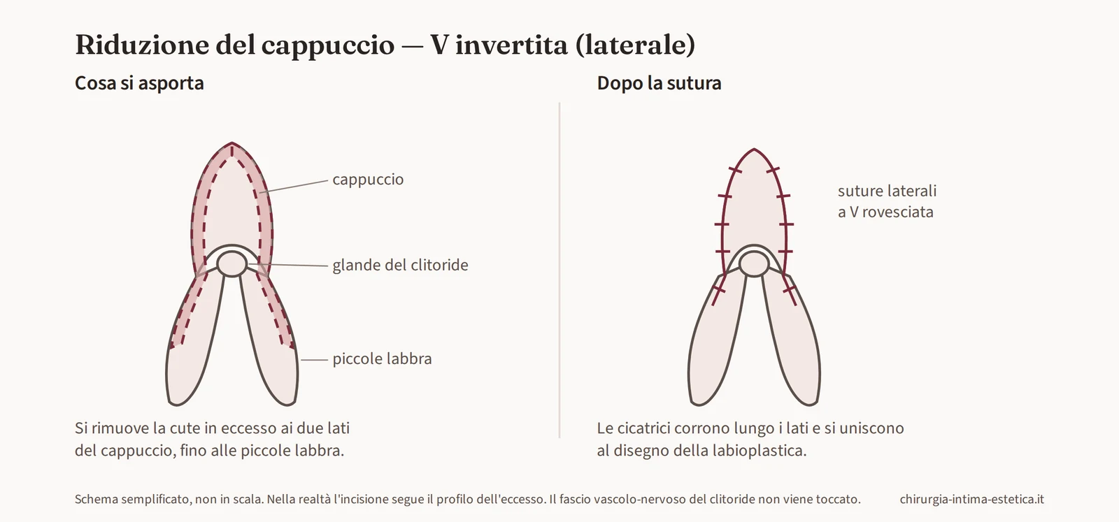 Schema della riduzione del cappuccio a V invertita: asportazione della cute in eccesso ai lati del cappuccio, in continuità con le piccole labbra