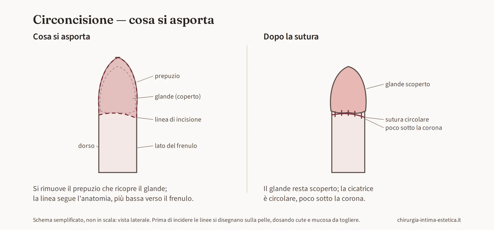 Schema della circoncisione in vista laterale: il prepuzio che ricopre il glande viene asportato e la sutura circolare cade poco sotto la corona