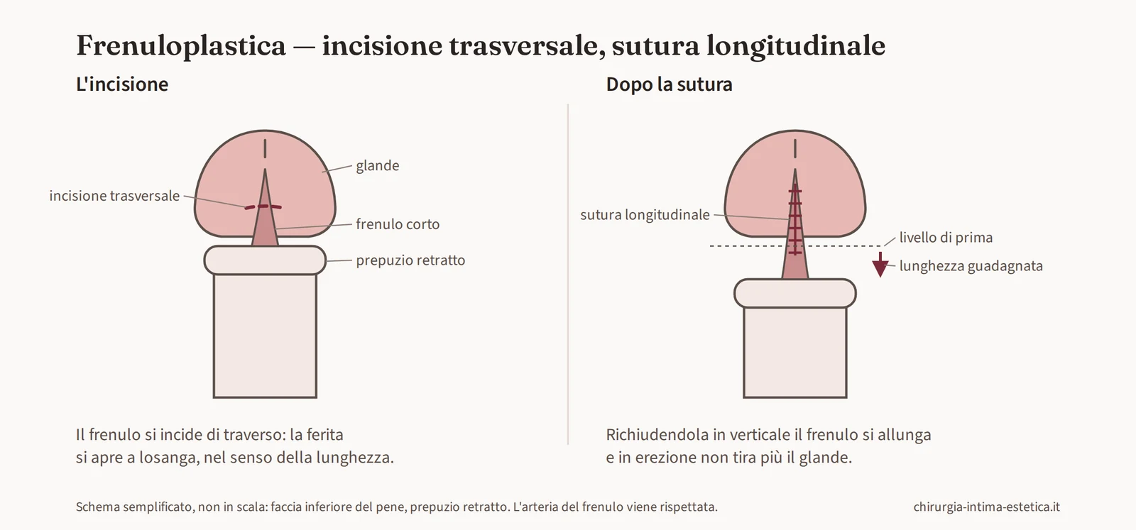 Schema della frenuloplastica: incisione trasversale del frenulo corto e sutura longitudinale che ne aumenta la lunghezza
