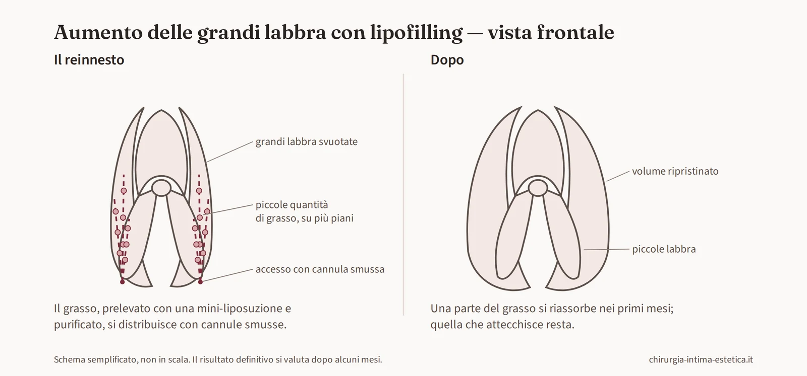 Schema del lipofilling delle grandi labbra in vista frontale: piccole quantità di grasso vengono distribuite con una cannula smussa su più piani e le grandi labbra recuperano volume