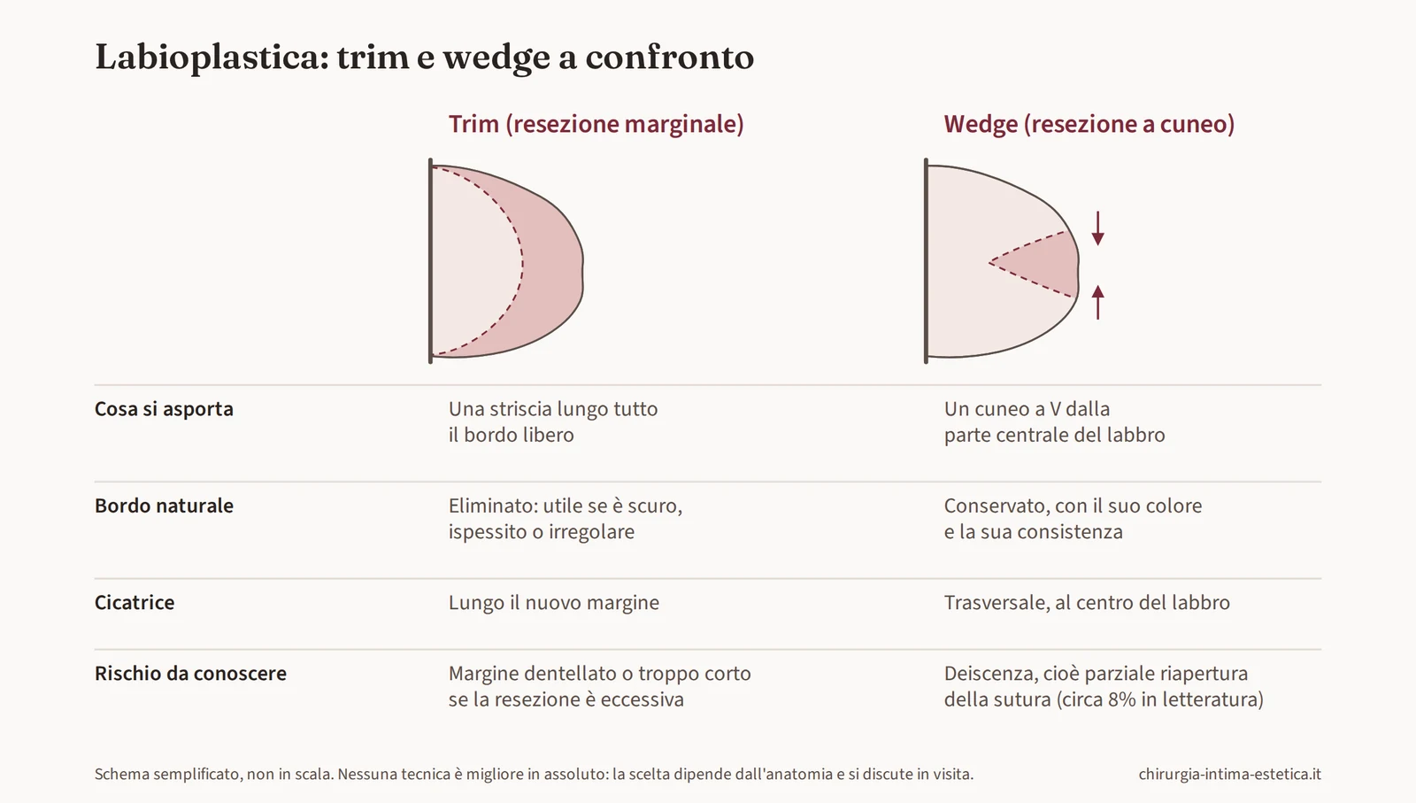 Schema di confronto tra labioplastica trim e wedge: cosa si asporta, bordo naturale, cicatrice e rischio principale di ciascuna tecnica