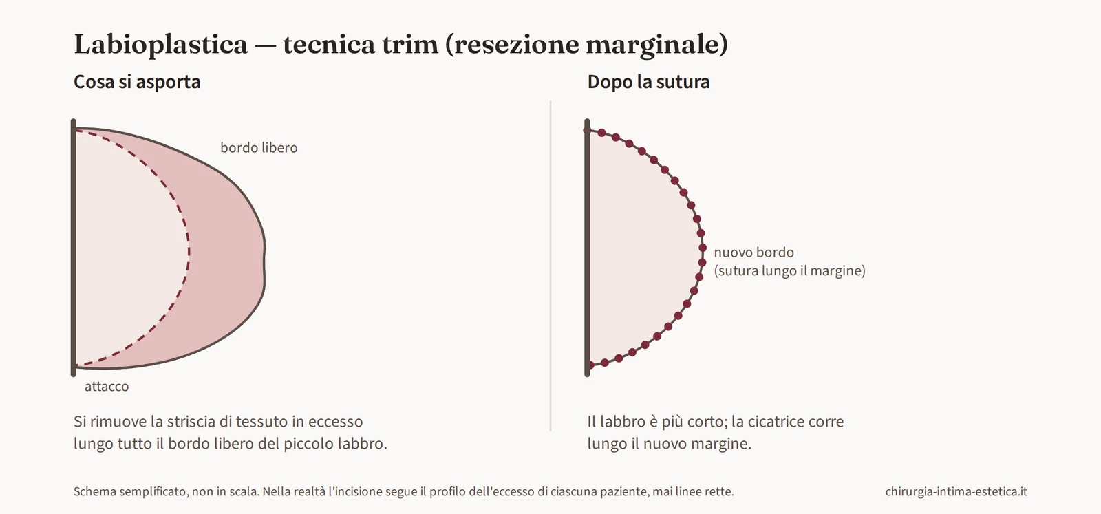 Schema della labioplastica trim: asportazione di una striscia di tessuto lungo il bordo libero del piccolo labbro, più ampia al centro e rastremata alle estremità