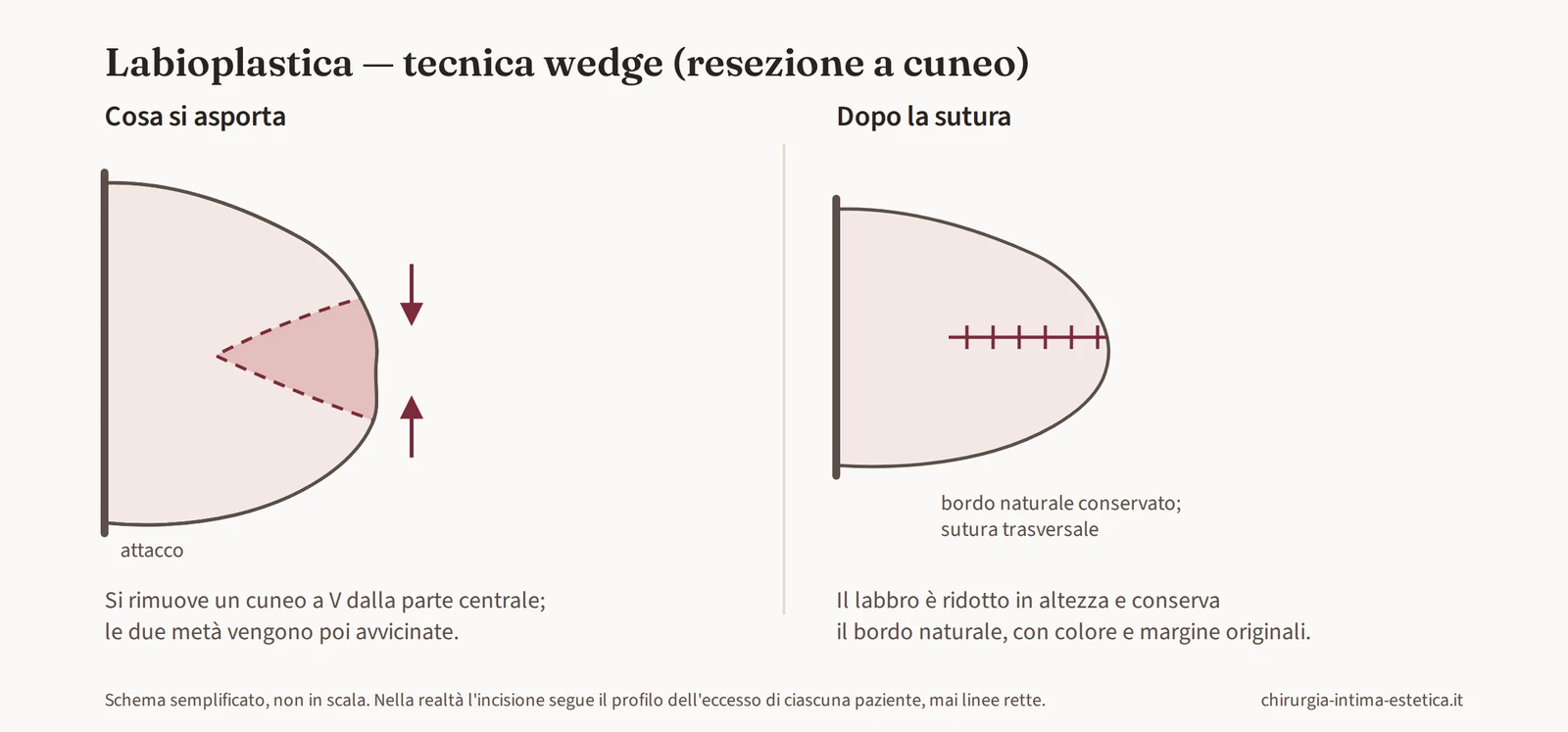 Schema della labioplastica wedge: asportazione di un cuneo a V dalla parte centrale del piccolo labbro e sutura trasversale che conserva il bordo naturale