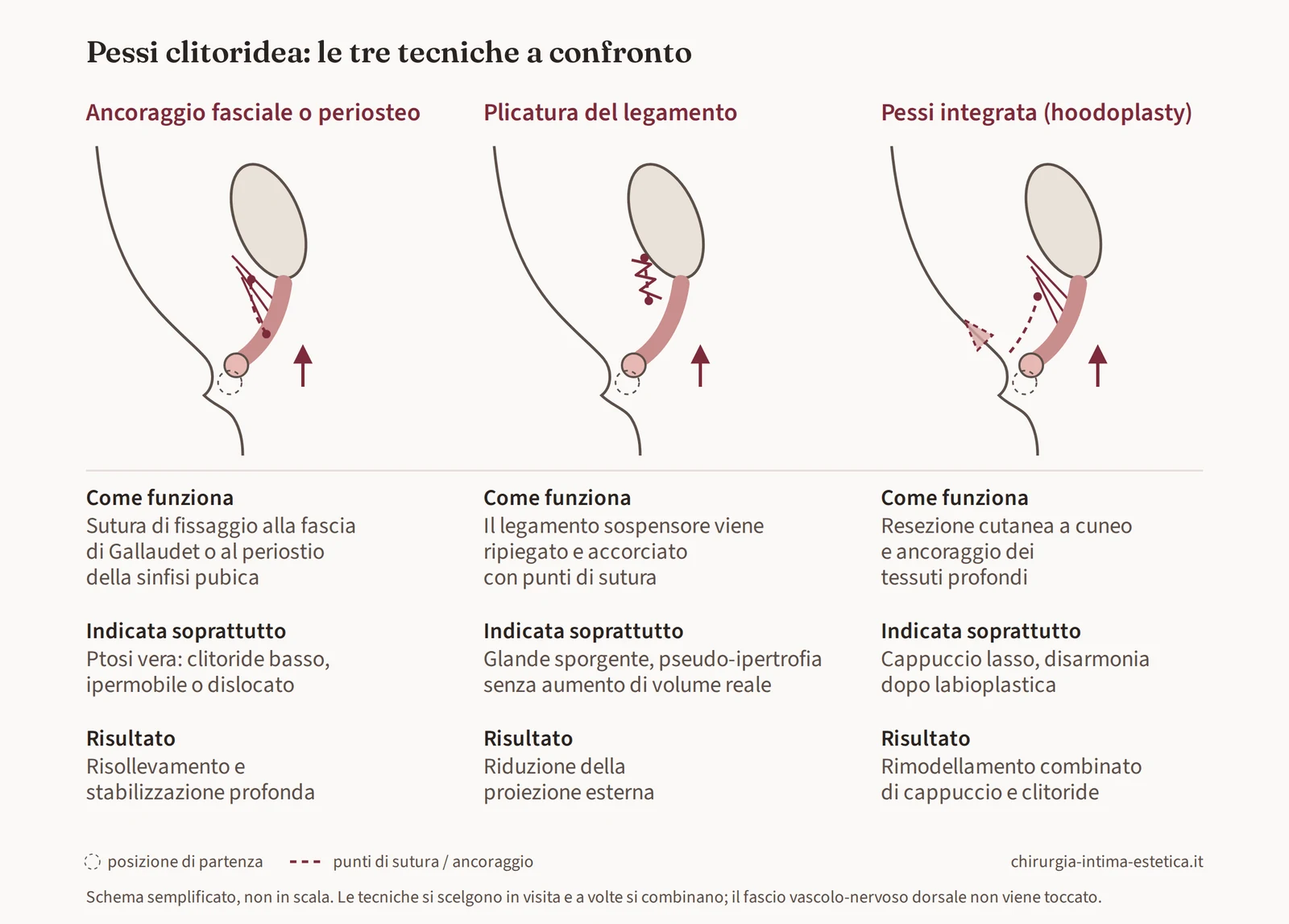 Schema di confronto delle tre tecniche di pessi clitoridea: ancoraggio fasciale o periosteo, plicatura del legamento sospensore e pessi integrata con riduzione del cappuccio
