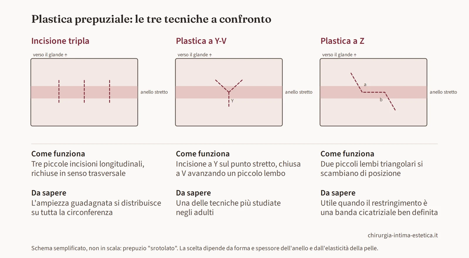 Schema di confronto delle tre tecniche di plastica prepuziale: incisione tripla, plastica a Y-V e plastica a Z