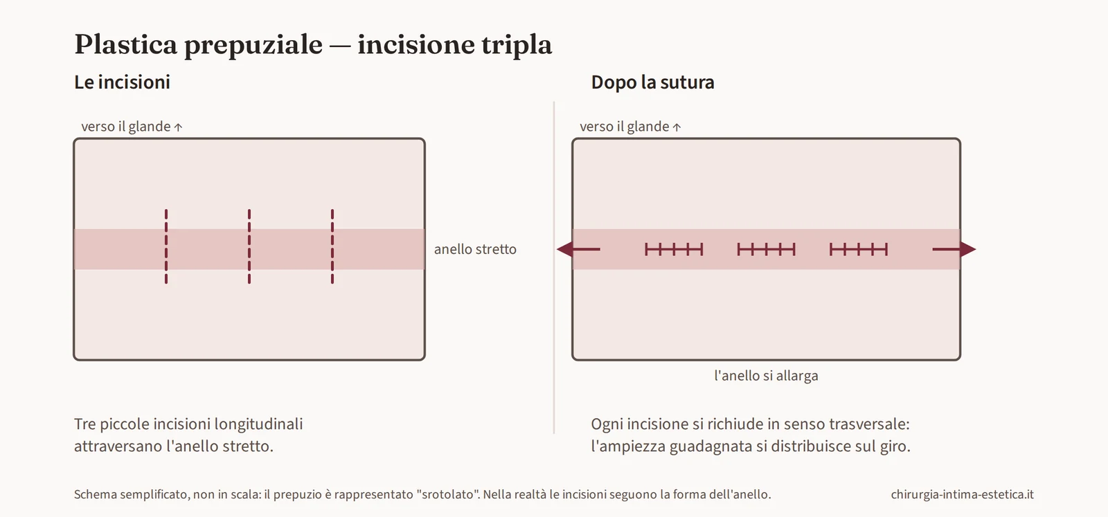 Schema dell'incisione tripla: tre incisioni longitudinali sull'anello stretto, richiuse in senso trasversale