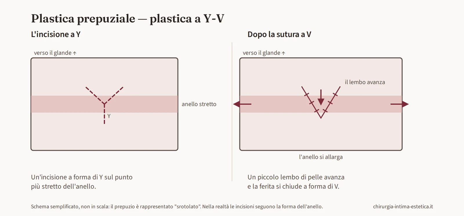 Schema della plastica a Y-V: incisione a Y sul punto stretto e chiusura a V con avanzamento di un piccolo lembo