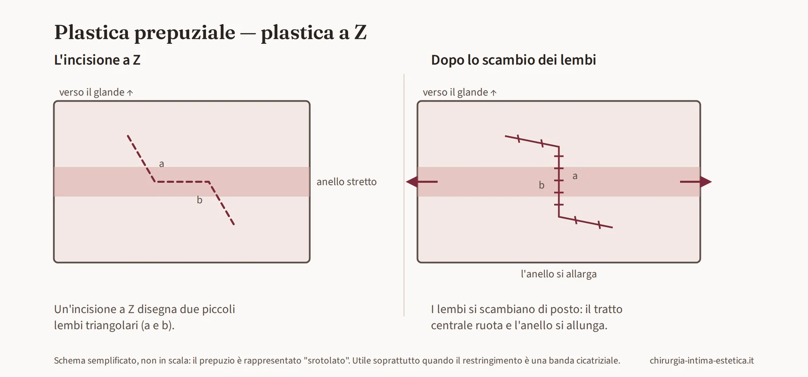 Schema della plastica a Z: due lembi triangolari che si scambiano di posizione allargando l'anello